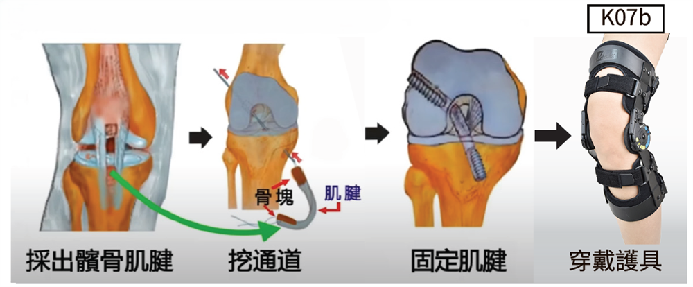ACL Surgery Steps